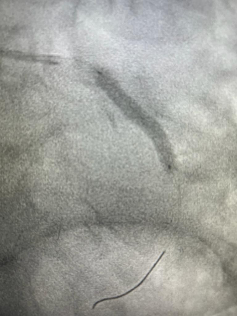 Angioplasty-2
