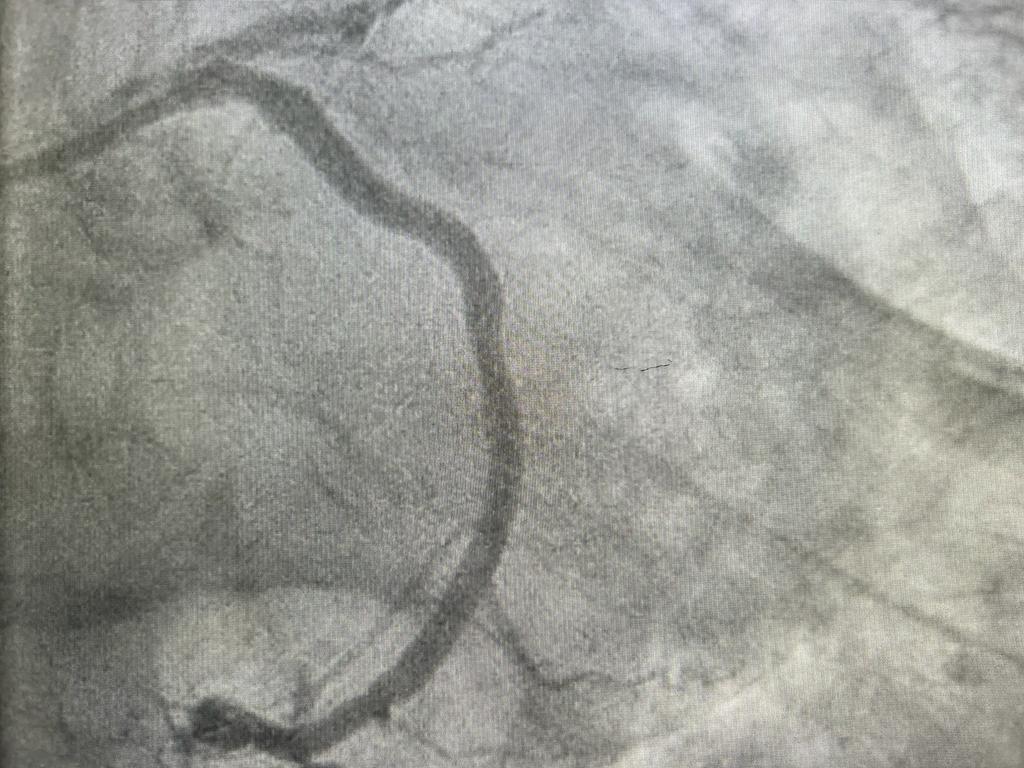 Angioplasty-3